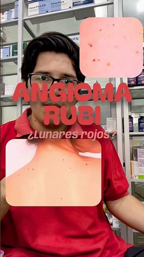 What Are Those Red Dots on Your Skin? 🔴 (Cherry Angioma)