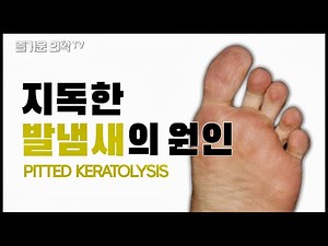 발냄새가 너무 심하신 분을 위한 영상! (소와각질융해증) [feat. 조폭마누라]
