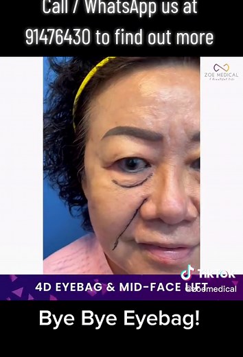 Non-Surgical 4D Eyebag & Midface Lift at Zoe Medical