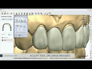 Full anatomy bridge design
