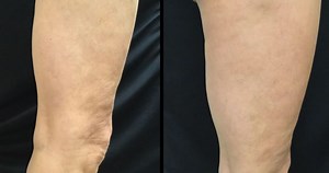 Thermage for Legs & Thighs - Dr. Michele Green M.D.