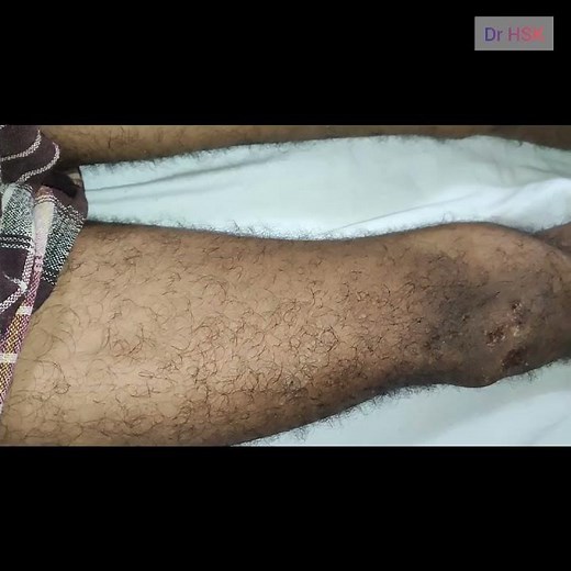 #muscle fasciculations in patient with MND