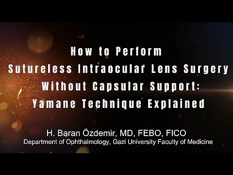 How to Perform Sutureless Intraocular Lens Surgery Without Capsular Support | Yamane Technique