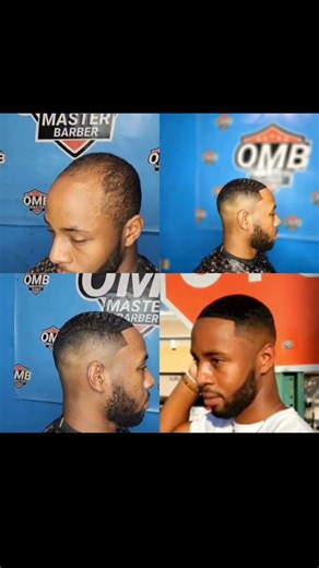Can We Bring His Hair Back? | Natural Hair Transformation | No Surgery Results