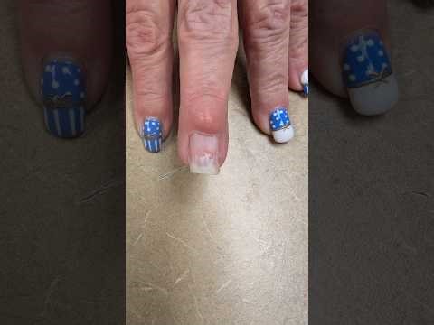 Mucous Cyst Excision