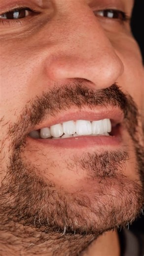 Dental Estetik on Instagram: "✨ From Bulgaria to a brand new smile! 🇧🇬😁 Mr. Mehmedali came in with periodontal issues and crown fit problems… and left with a FULL smile makeover! 💎 24 units in BL3 shade with zirconia substructure + Emax superstructure = natural, bright, and confident vibes! 🔥🦷 Now he’s ready to smile in every selfie 😄📸 #SmileMakeover #EmaxVeneers #core #cores #dentalaesthetics"