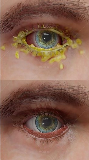 Bacterial or Allergic Conjunctivitis? Why the Right Diagnosis Matters