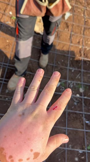 First Aid for Hand Injuries at Construction Sites