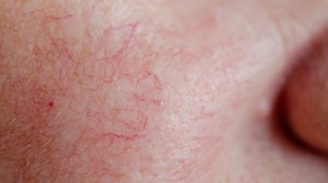 La rosacée ou couperose : causes, symptômes et traitements