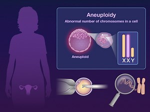 2.9K views · 65 reactions | Quick Take: Preimplantation Genetic Testing for Aneuploidy https://nej.md/3oWPiM8 | The New England Journal of Medicine | Facebook