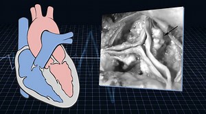 6.9K views · 86 reactions | A big-data analysis of more than 8,600 patient records by Vanderbilt University School of Engineering found a link between popular arthritis drug Celebrex and heart valve calcification. Read more: https://news.vanderbilt.edu/2019/02/22/study-links-celebrex-heart-valve-calcification-after-earlier-research-declared-drug-safe/ #valvediseaseday | Vanderbilt University | Facebook