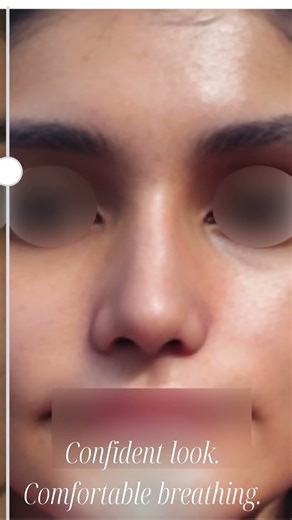 Struggling with breathing issues | Rhinoplasty & Septoplasty | Deviated Septum Problem #shorts #yt