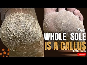The Whole Sole Is Callused!