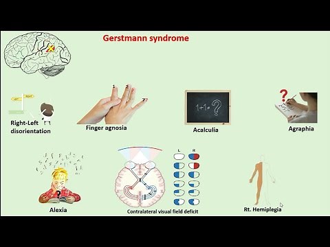Gerstmann syndrome | Alexia with Agraphia | angular gyrus