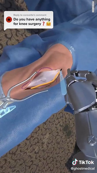 Replying to @corevette Yes! We have “WRAITH VR Total Knee Replacement Surgery Simulation” available to play on STEAM. You can also find it on our website theough the link in the bio. #kneesurgery #medicalhumor #surgicaltraining