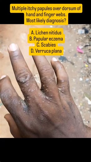 Dr. Monu kumar on Instagram: "Interdigital papules + intense itching? Think beyond eczema 👀 👉 SCABIES is the answer! 🦠 Common disease, commonly missed #Scabies #DermatologyMCQ #ImageBasedQuestion"