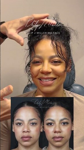 Alar Base Reduction! 3 Months Post Op!