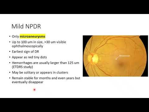 Diabetic retinopathy – Classification and stages