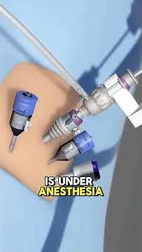 Hysterectomy Surgery (3D Animation) | Step-by-Step Procedure Explained #foryou #shorts #shortvideo