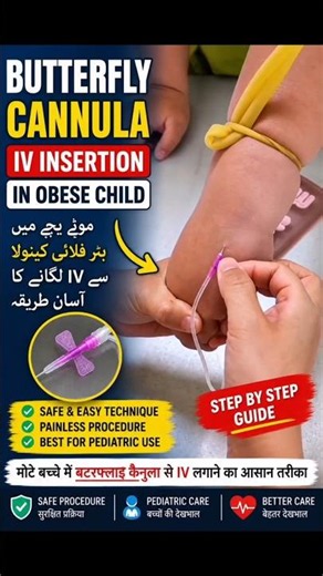 Butterfly Cannula IV Insertion in Obese Child #shorts