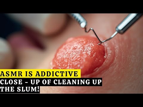 30 MINUTES OF RELAXATION! Full Face Acne & Blackhead Removal (Satisfaction ASMR).