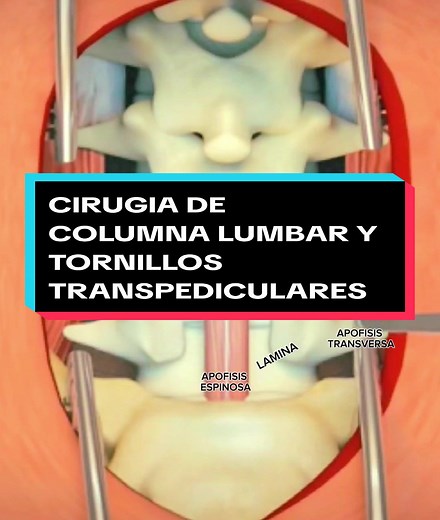 Lumbar Spine Surgery with Transpedicular Screws