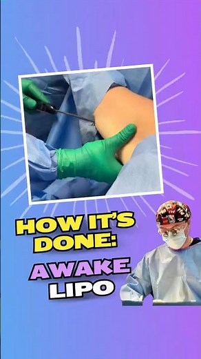 How It’s Done: Awake Liposuction | Underarm VASER Lipo With Simple Oral Sedation