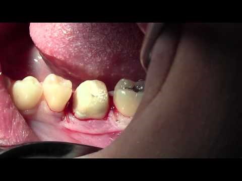 Clinical Crown Lengthening #19, Before & After