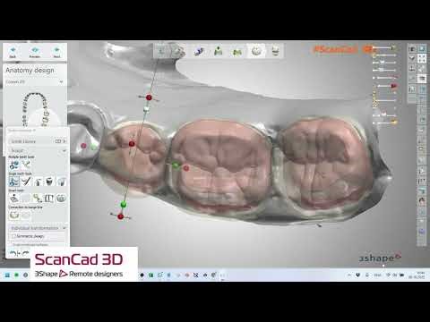 3shape crowns 10-08-2025 L