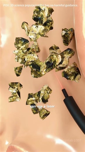 Ureteroscopy Procedure #ureteroscopy #ureteroscope #uterusproblems #kidneystone #kidneystones