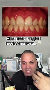Drug-induced gingival hyperplasia: be careful with these medications 🦷
