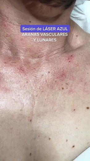 Rejuvenece tu escote con Láser Azul Blauman en 1 o 2 sesiones. Pide cita al 📱699 054 965 Barcelona, alrededores y Roda de Berà. Mira qué otras lesiones estéticas podemos eliminar 👀 . @Laserllum @Laserllum #arañasvasculares #rejuvenecerescote #laserazul #laserazulblauman #especialistasenlaser #laserllum