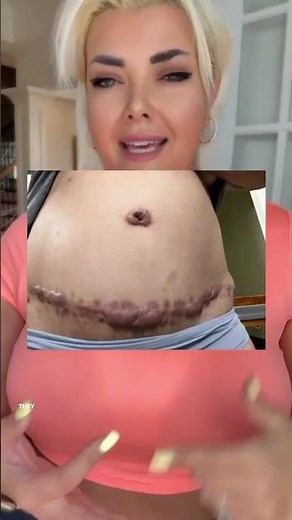 My Stomach After Lipo ONLY!!! #tummytuck