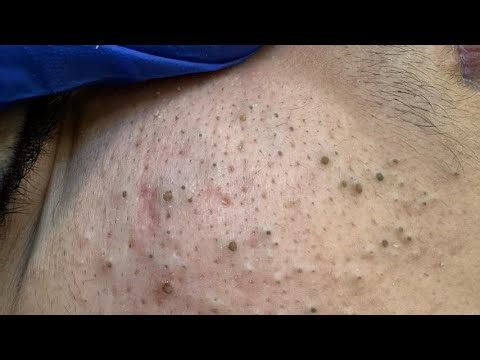 Maya Facial Care Routine (Say Goodbye to Pimples & Blackheads)