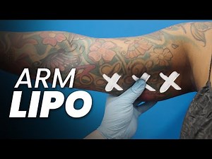 Defining Your Arms with Expert Liposuction