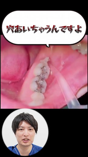 親知らず抜歯の注意点と穴が開くリスク