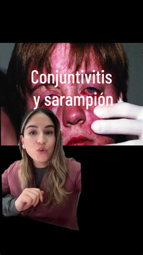 Ya revisaste q tu esquema de vacunación esté al día? . . . Koenig KL, Alassaf QW, Burns MJ. Identify-Isolate-Inform: a tool for initial detection and management of measles patients in the emergency department. West J Emerg Med. 2015;16(2):212–219. doi:10.5811/westjem.2015.3.25678