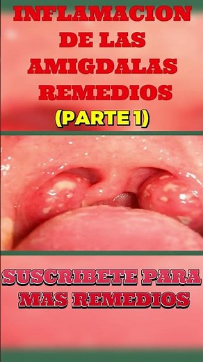 Inflamacion De Amigdalas Remedios ◷ Como Bajar Inflamacion De Amigdalas (PARTE 1)