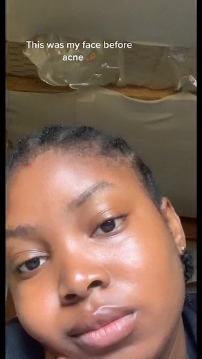 Understanding Cystic Acne: Causes and Treatment