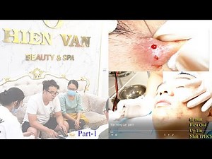 Remove and Clean many Cyst in younger at Hien Van Spa|345|Hồng lai