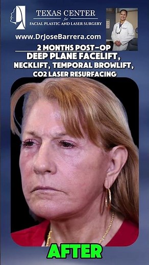 2 months after a Preservation Deep Plane Facelift, Neck Lift, Temporal Browlift, and CO2 Laser