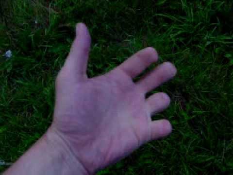 Partial Hand Amputee