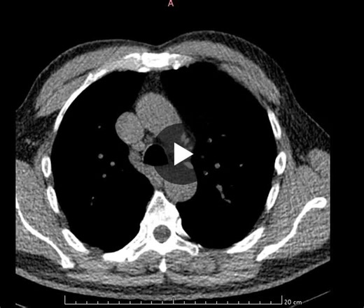 High Coronary Calcium Score: Early Warning for Heart Disease | Kowshik M posted on the topic | LinkedIn