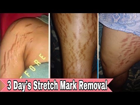 stretch mark removal / how to remove stretch mark using baking soda & lemon get rid of stretch marks