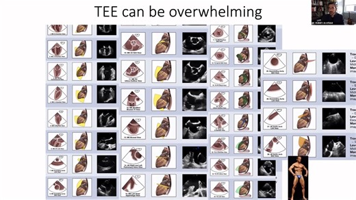 TEE经食道心脏超声MTL-SONO 2020： Transesophageal Echocardiography