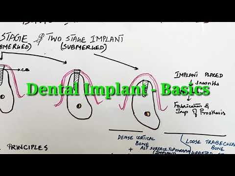 Dental Implant Basics- one stage and two stage implant surgical protocol