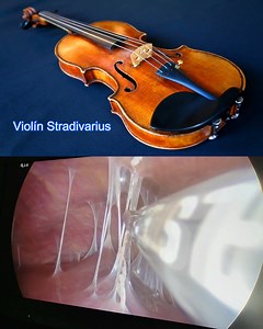 En este video se muestra una perihepatitis por síndrome de Fitz-Hugh–Curtis en donde se aprecian las clásicas adherencias en “cuerdas de violín”, reflejo del daño inflamatorio perihepático. Como metáfora para el aprendizaje efectivo ... recuerda a los violines Stradivarius, auténticas obras maestras alcanzando valores millonarios en el mercado del arte musical. | Posgrado de Anestesiología de la Universidad de Costa Rica