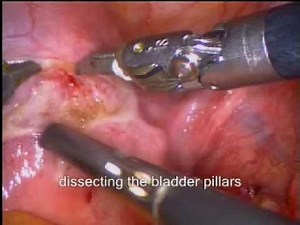 Pelvic Floor Correction By Laparoscopic Uterus Excision (Supracervically) • Video • MEDtube.net