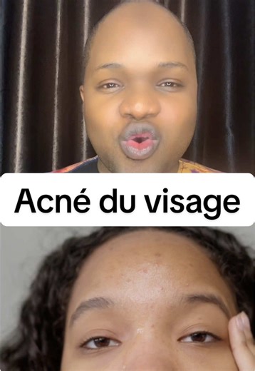 Acné du visage : Que faire pour se débarrasser des boutons ?