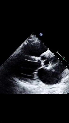 Heart Matters on Instagram: "Interatrial septal aneurysm (IASA) ● What is it? A localized, excessive bulging of the interatrial septum (usually at the fossa ovalis) into one or both atria. 📏 Diagnostic definition (echo): Septal excursion ≥ 10–15 mm beyond the atrial septal plane during the cardiac cycle. ● How it moves May bulge: ▪︎ Toward RA ▪︎ Toward LA ▪︎ Bidirectional (most common) Movement often varies with respiration and atrial pressures. ● Associations (very important 🔑) IASA is rarely